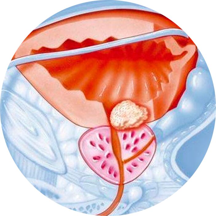 Prostate adenoma